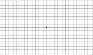 습성 연령관련 황반변성 증상이 없을 때 보이는 암슬러 격자