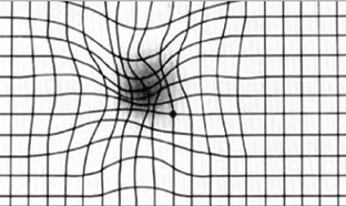 습성 연령관련 황반변성 증상이 있을 때 보이는 암슬러 격자