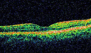건강한 눈의 OCT 이미지